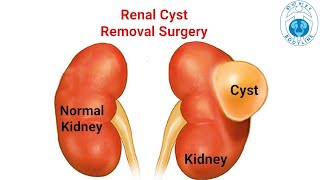 Laparoscopic Renal Cyst Deroofing Bodylinehospitals by drutsavshahurologist done successfully [upl. by Horatio114]