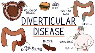 Understanding Diverticulosis and Diverticulitis [upl. by Annovahs]