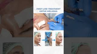 FIRST LINE TREATMENT UNTUK MELASMA klinikkecantikan [upl. by Nylloh]