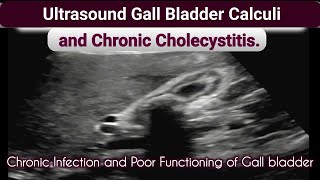 Ultrasound Gall bladder Chronic Cholecystitis and Calculi [upl. by Ahsiret]