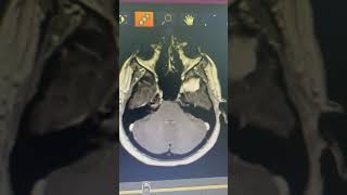 meningioma resection [upl. by Asset724]