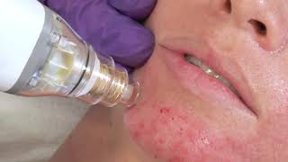 Potenza Microneedling Treatment BHP [upl. by Ditmore264]