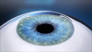 Cirurgia Refrativa a Laser  Lasik [upl. by Turmel]