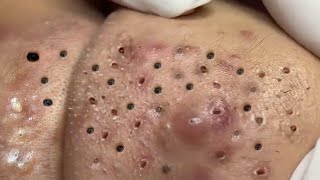 Big Cystic Acne Blackheads Extraction Blackheads amp Milia Whiteheads Removal Pimple Popping  4546 [upl. by Mercorr]