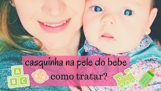 Casquinha na pele do bebe como tratar crosta lactea [upl. by Ennovyhs]