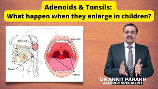 Adenoids amp Tonsils What happen when they enlarge in children I Dr Ankit Parakh Child Pulmonologist [upl. by Leuas]