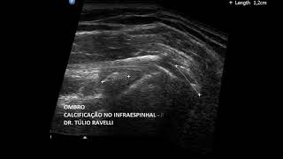 Ultrassom do Ombro  Tendinopatias e lesões do Infraespinhal [upl. by Sabanrab]