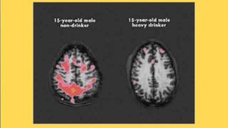 Alcohol and Addiction How it affects the Brain [upl. by Anyr355]