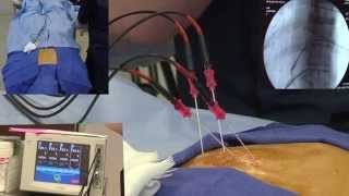 Radiofrequency Ablation Explanation Video Demonstration  LIVE [upl. by Ahsienom28]