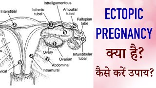 Ectopic Pregnancy Symptoms in Hindi  Ectopic Pregnancy ke Lakshan causes explained in hindi [upl. by Audsley593]