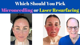 Should You Get Microneedling or Laser Resurfacing  Plastic Surgeons Advice [upl. by Greiner]