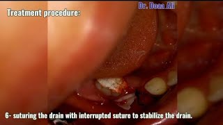 What is the role of drain in treatment of odontogenic infection [upl. by Adyam]