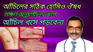 আঁচিলের সঠিক হোমিওপ্যাথিক ঔষধ  best homeopathic medicine for warts  Dr SP Goswami [upl. by Aciram760]