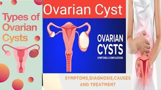 Ovarian Cyst Cyst in Ovary What are Ovarian Cyst [upl. by Kate]