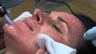 Dr Mark B Taylor Review of Dermapen Micro Needling  Gateway Aesthetics [upl. by Kubetz]