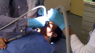 Tooth filling in school dental clinic Part 13 Tooth filling [upl. by Alidia]