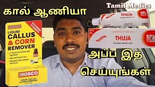 ஒரே மாதத்தில் கால் ஆணி சரியாக I Corn and callus Treatment in Tamil [upl. by Ellehsram759]