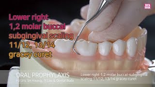 Lower right 12 molar buccal subgingival scaling 1112 1314 gracey curet [upl. by Liddy]