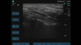 USGCervical Medial Branch Nerve Block [upl. by Etnoled]