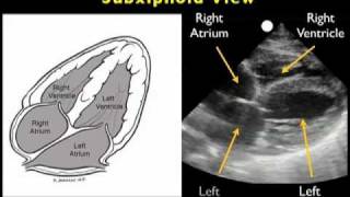 How to Echocardiography  Subxiphoid View [upl. by Julia]