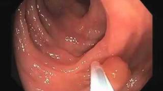 Colonoscopy Video Tour Removal of a Colon Polyp Polypectomy [upl. by Hayikaz]