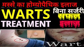 homeopathic treatment for warts and migraine live case taking drrajeshmanghnaniwwwehomeovision [upl. by Cuthburt]