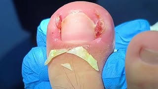 Trimming and Removing Huge Ingrown Toenails [upl. by Eenattirb]