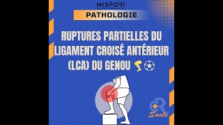 Rupture Partielle du LCA  Comprendre Diagnostiquer et Traiter LCA Kinésithérapie [upl. by Akili395]