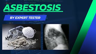 Asbestosis  Pneumoconiosis  Causes  Symptoms  Diagnosis  Treatment amp Pathology [upl. by Treblih]