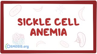 Sickle cell anemia  causes symptoms diagnosis treatment amp pathology [upl. by Skiba]