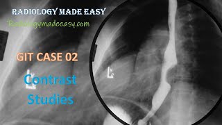 FRCR Radiology  A 60 year old patient presented with progressive dysphagia  GIT Contrast Study 02 [upl. by Beaufort910]