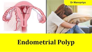 Endometrial polyp can I get pregnant in Tamil [upl. by Grochow]