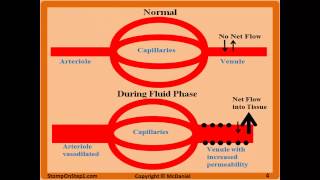 Acute Inflammation Vascular Permeability amp Vasodilation Fluid Phase Macrophage Neutrophil [upl. by Aiello]