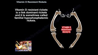 Vitamin D Resistant Rickets  Everything You Need To Know  Dr Nabil Ebraheim [upl. by Eugenle]