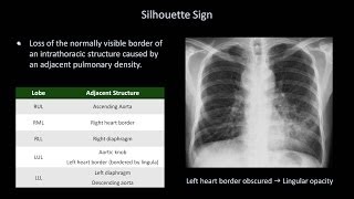 How to Interpret a Chest XRay Lesson 8  Focal Lung Processes [upl. by Ahsinan]