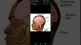 icecream headache brainfreeze colddrinks trigeminalnerve brain symptoms causes medicine [upl. by Shornick844]