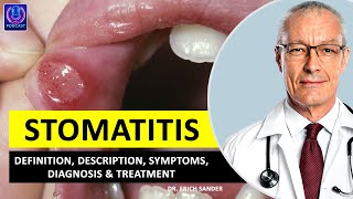 STOMATITIS Definition Description Causes and symptoms Diagnosis amp Treatment of Stomatitis [upl. by Patric362]