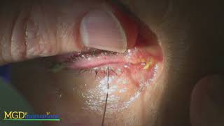 Meibomian Gland Dysfunction MGD Probing Steps Using the Maskin Protocol [upl. by Jimmy]