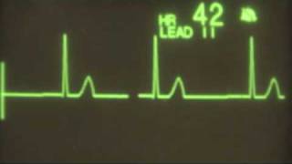 Junctional Bradycardia  ECG Training [upl. by Eirojam]