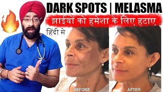 Permanently Cure DARK SPOTS झाइयां MELASMA HYPERPIGMENTATION or BLACK MARKS ENG SUBTITLES [upl. by Heather]