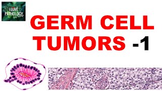 OVARIAN TUMORS  Part 4 Germ cell tumors Dysgerminoma yolk sac tumor  Pathology [upl. by Dasa]