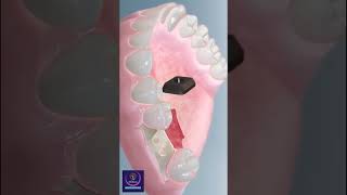 Molar Implant Surgery dentistry [upl. by Noxid959]