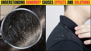 What is Dandruff  Causes And Treatment [upl. by Tinor]