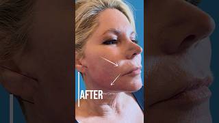 PDO Thread Lift Before and After PCH MedSpa Newport Beach [upl. by Aicek]