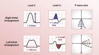 Intro to EKG Interpretation  Chamber Enlargement [upl. by Efthim]