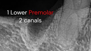 Endodontic treatment Lower premolar 2 canals [upl. by Eirotal]