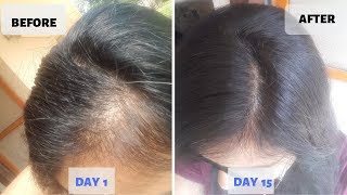 OMG  15 Days Hair Growth Miracle Treatment  Grow Long Thicken Hair  100 works [upl. by Eelrebma790]