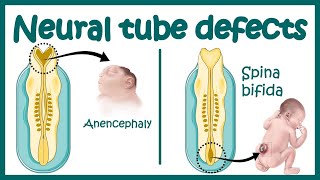 Neural Tube Defect  Overview  signs and symptoms of neural tube defect pathophysiology amp treatment [upl. by Sachiko]