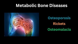 Metabolic bone disease Osteoporosis Rickets amp Osteomalacia A complete guide [upl. by Amles946]