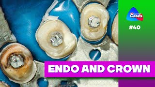 ENDO and crown  BG Dental Cases 40 Belogradacademy [upl. by Aileek]